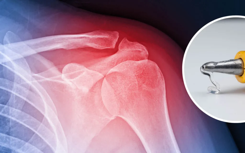 हड्डी टूटने का इलाज अब मिनटों में – जानिए 'बोन ग्लू' की ताकत 1 Bone Joining Glue