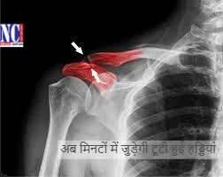 हड्डी टूटने का इलाज अब मिनटों में – जानिए ‘बोन ग्लू’ की ताकत
